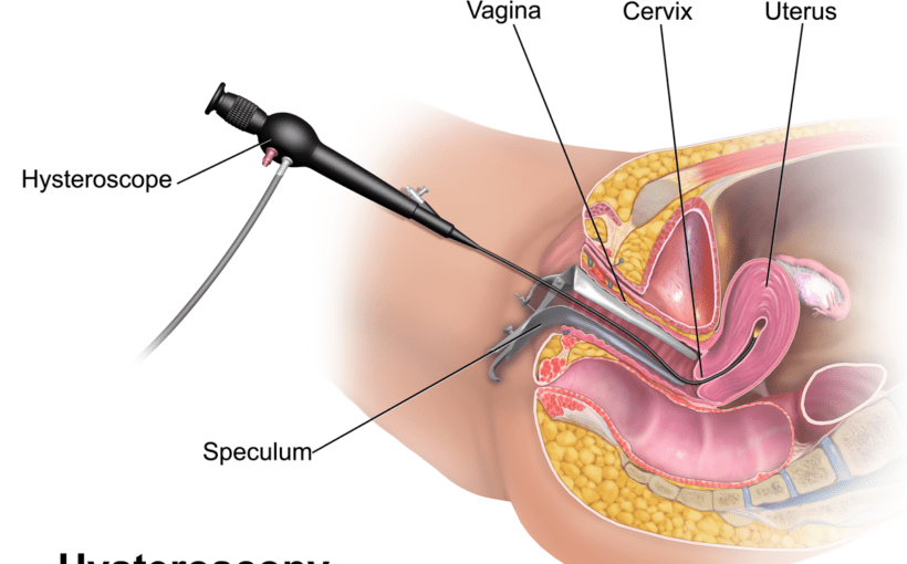 hysteroscopy